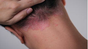 Ilustrasi psoriasis dengan plak kemerahan dan sisik putih pada kulit kepala