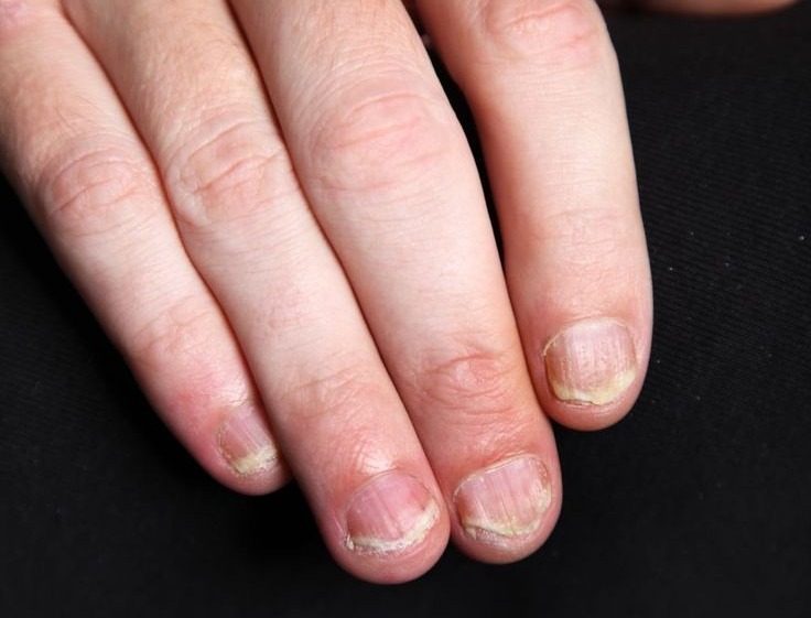 psoriasis kuku