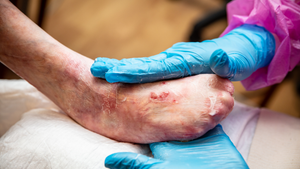Epidermolysis Bullosa