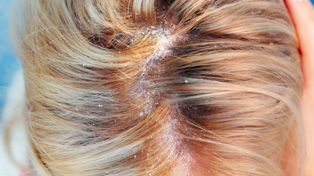 dermatitis seboroik